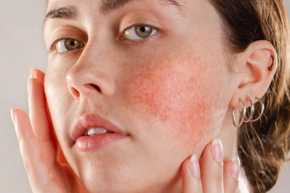 Rosacea Treatments at The Park Medspa in Highland Park, NJ