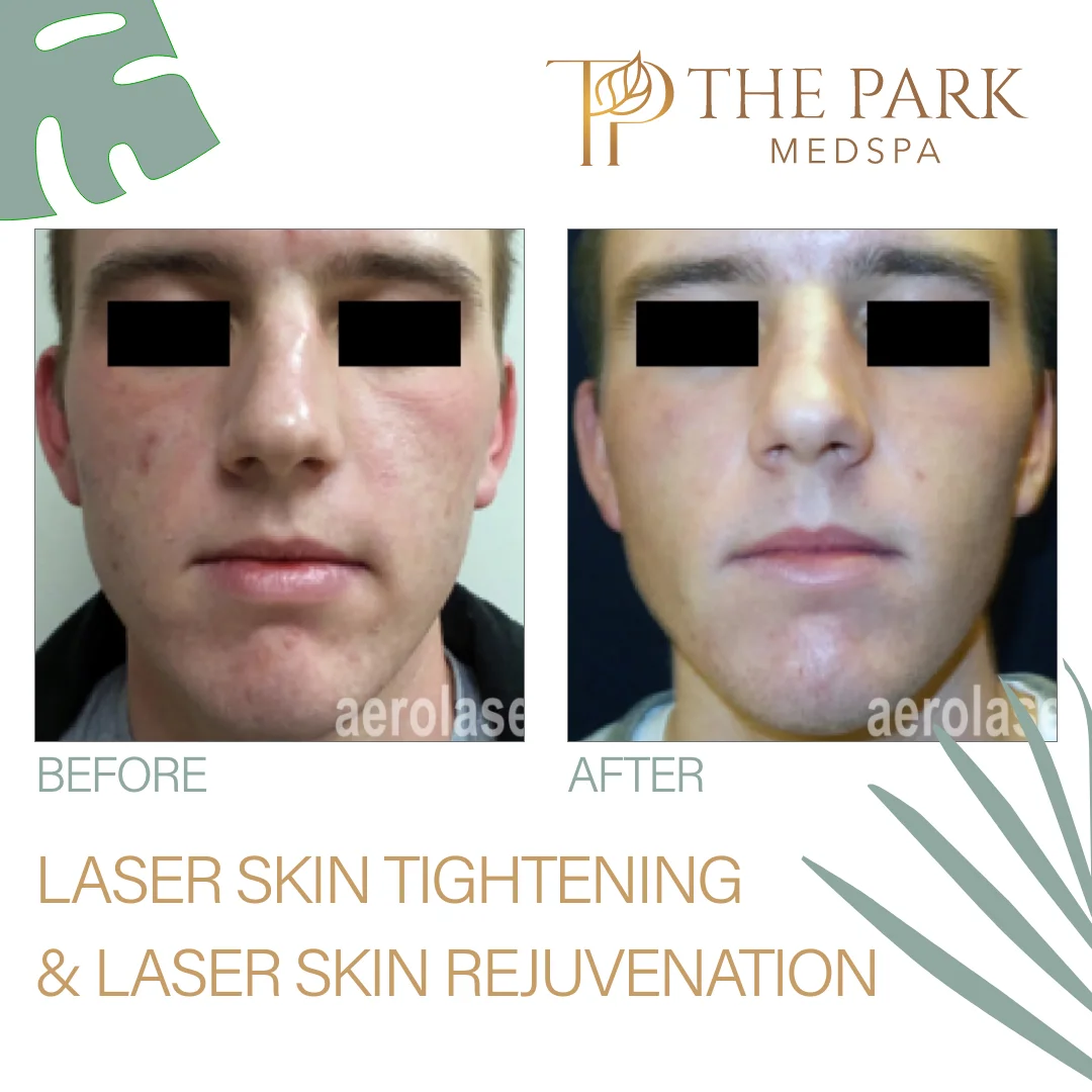 Laser Skin Rejuvenation Treatment at The Park Medspa in Highland Park, NJ