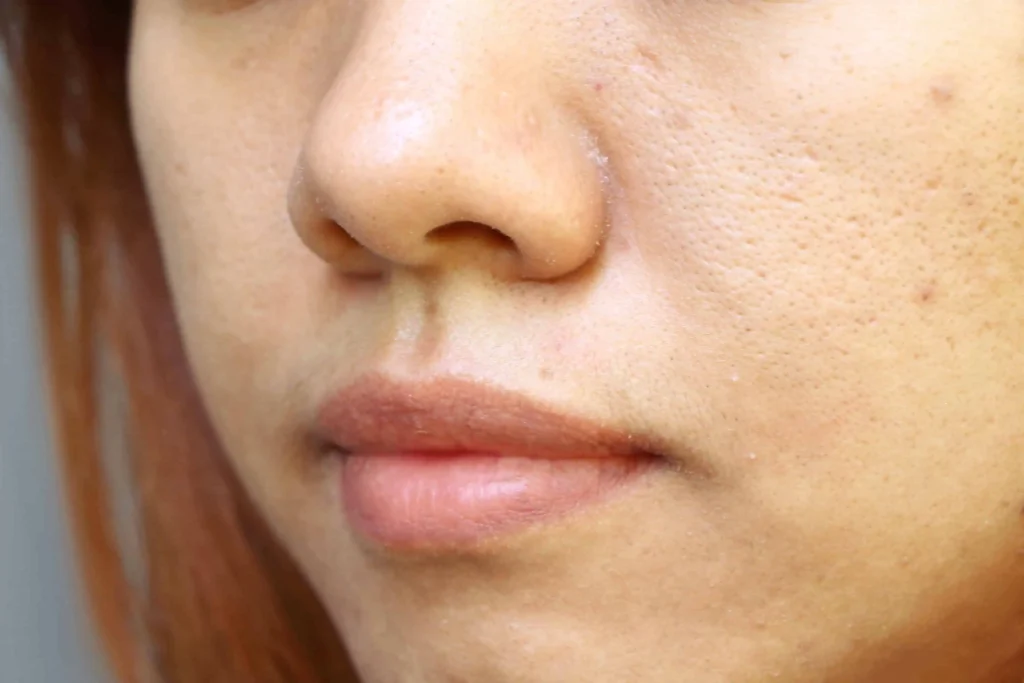 Large Pores Treatment | Portfolio