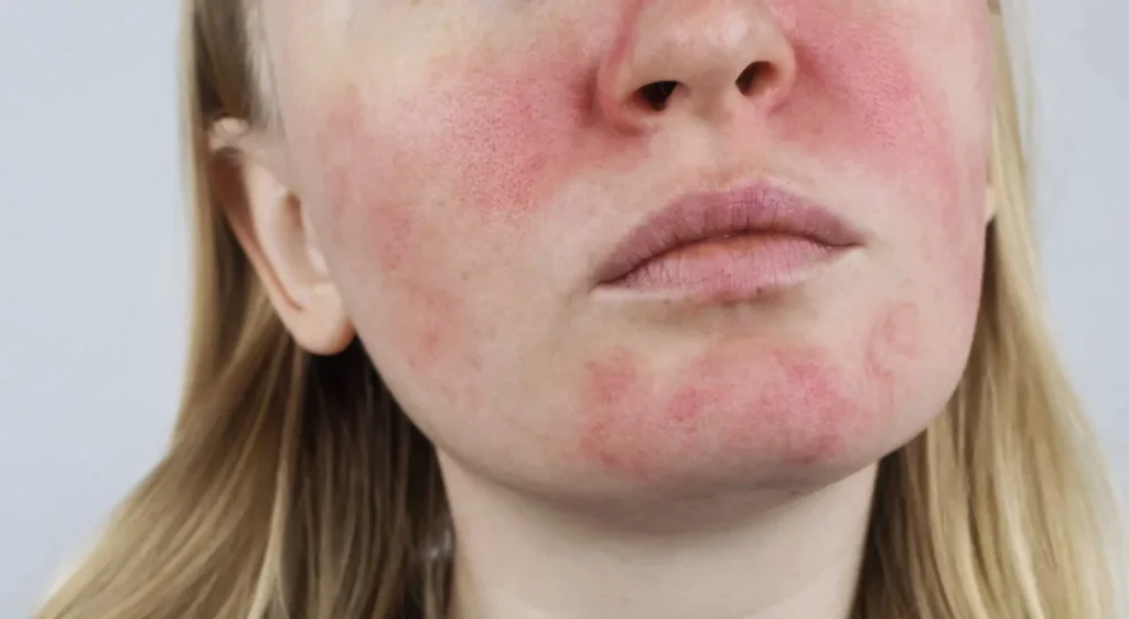 Rosacea Redness Treatment scaled e1742578695834 | Portfolio