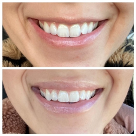 Lip Flip: What Is It and Is It Something You Should Consider? 3 lip flip after blog thepark medspa in Highland Park NJ | Lip Flip: What Is It and Is It Something You Should Consider?