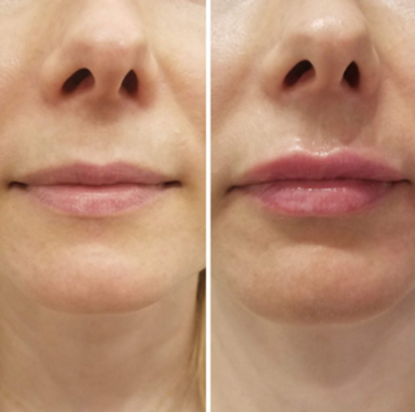 Lip Flip: What Is It and Is It Something You Should Consider? 2 lip flip before after blog thepark medspa in Highland Park NJ | Lip Flip: What Is It and Is It Something You Should Consider?
