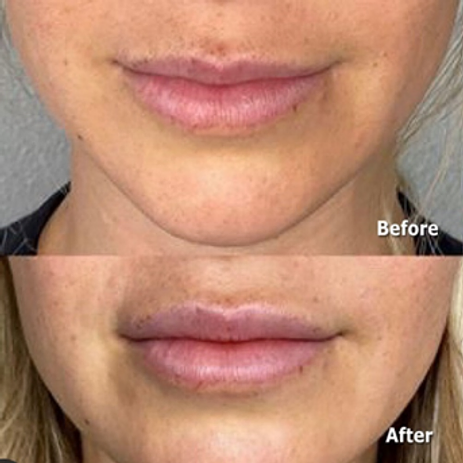 Lip Flip: What Is It and Is It Something You Should Consider? 1 lip flip before blog thepark medspa in Highland Park NJ | Lip Flip: What Is It and Is It Something You Should Consider?