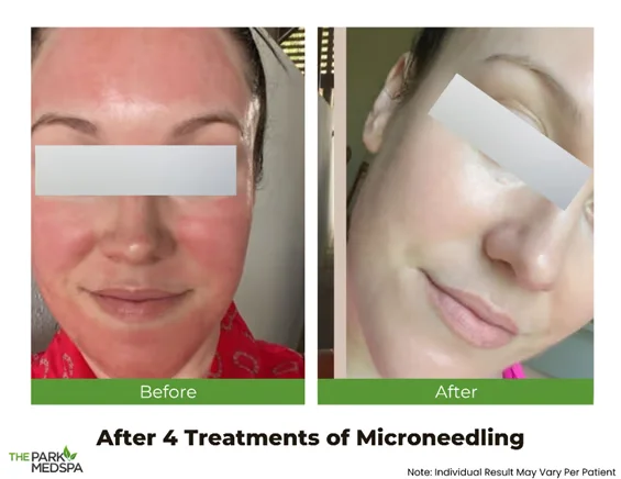 Microneedling vs. Laser Resurfacing: Which is Best for Skin Tightening? 1 microneedling the result blog thepark medspa in Highland Park NJ | Microneedling vs. Laser Resurfacing: Which is Best for Skin Tightening?