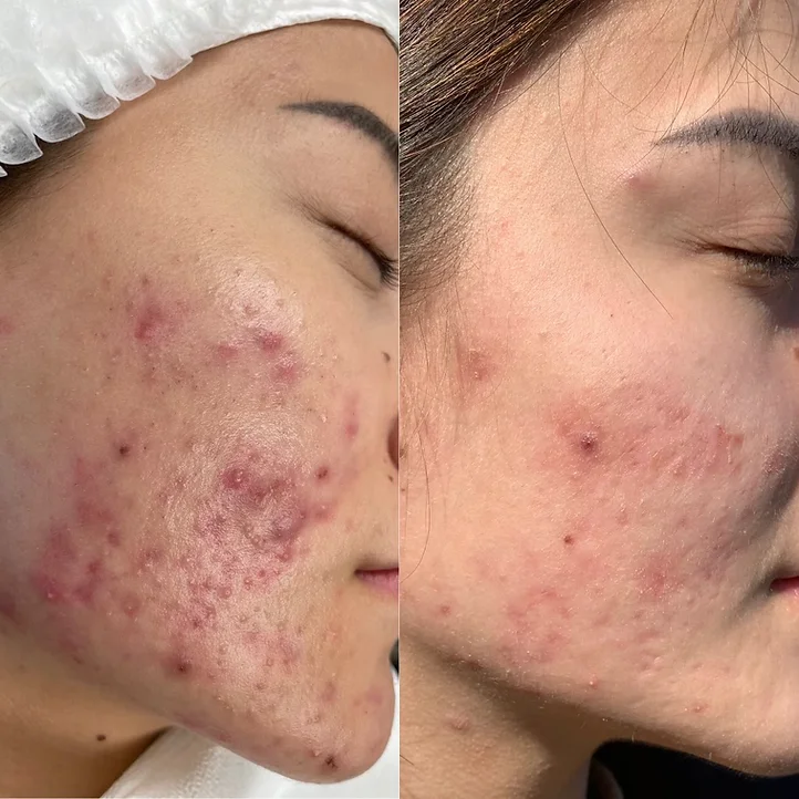 Before & After Acne Treatment by The Park Medspa in Highland Park, NJ