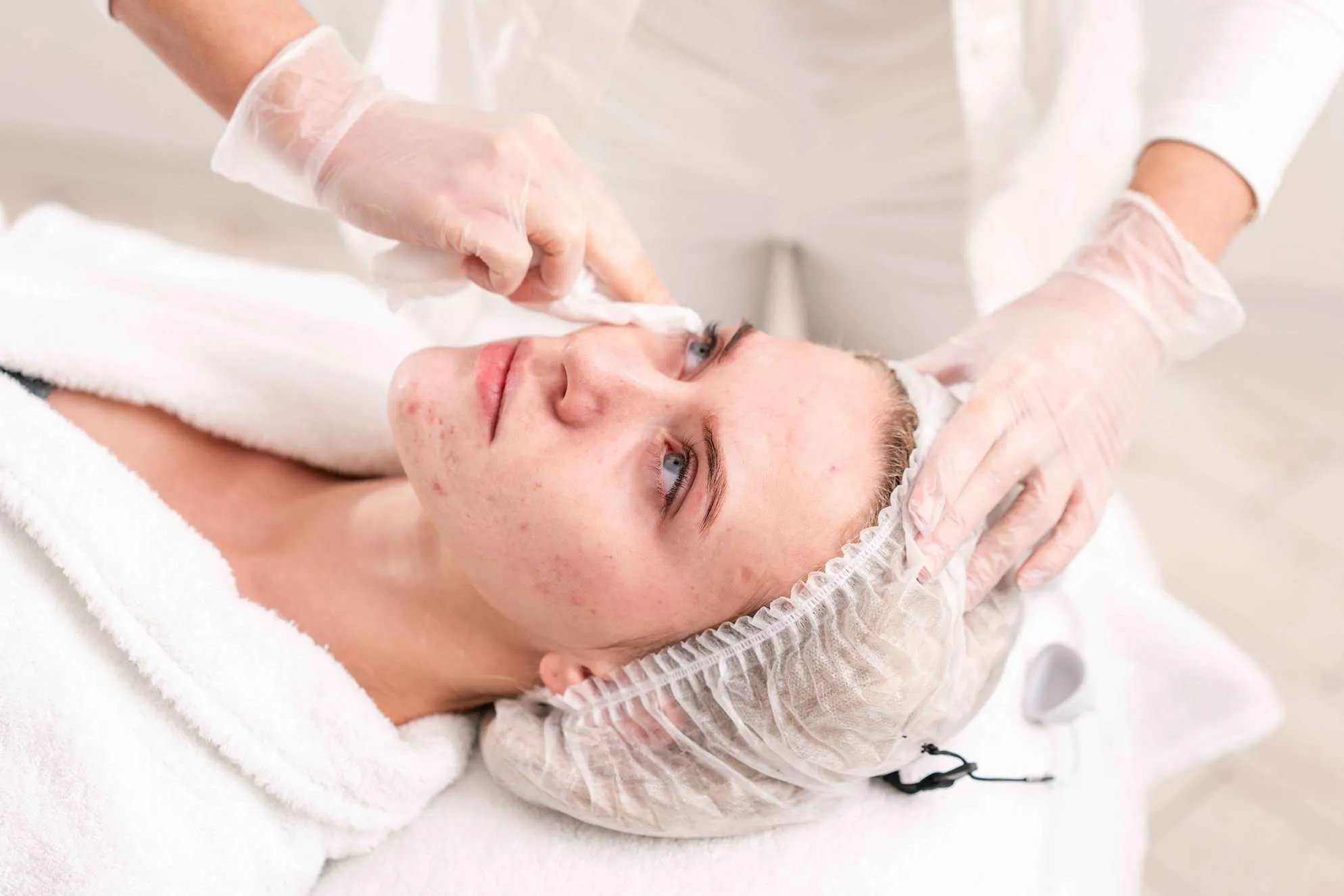 Acne Treatment at The Park Medspa in Highland Park, NJ