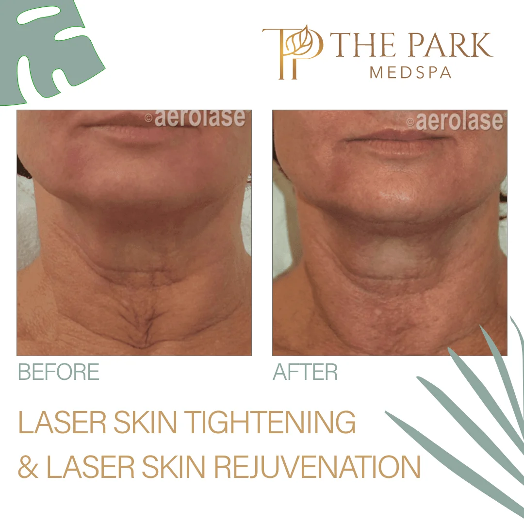 Laser Skin Rejuvenation Treatment at The Park Medspa in Highland Park, NJ