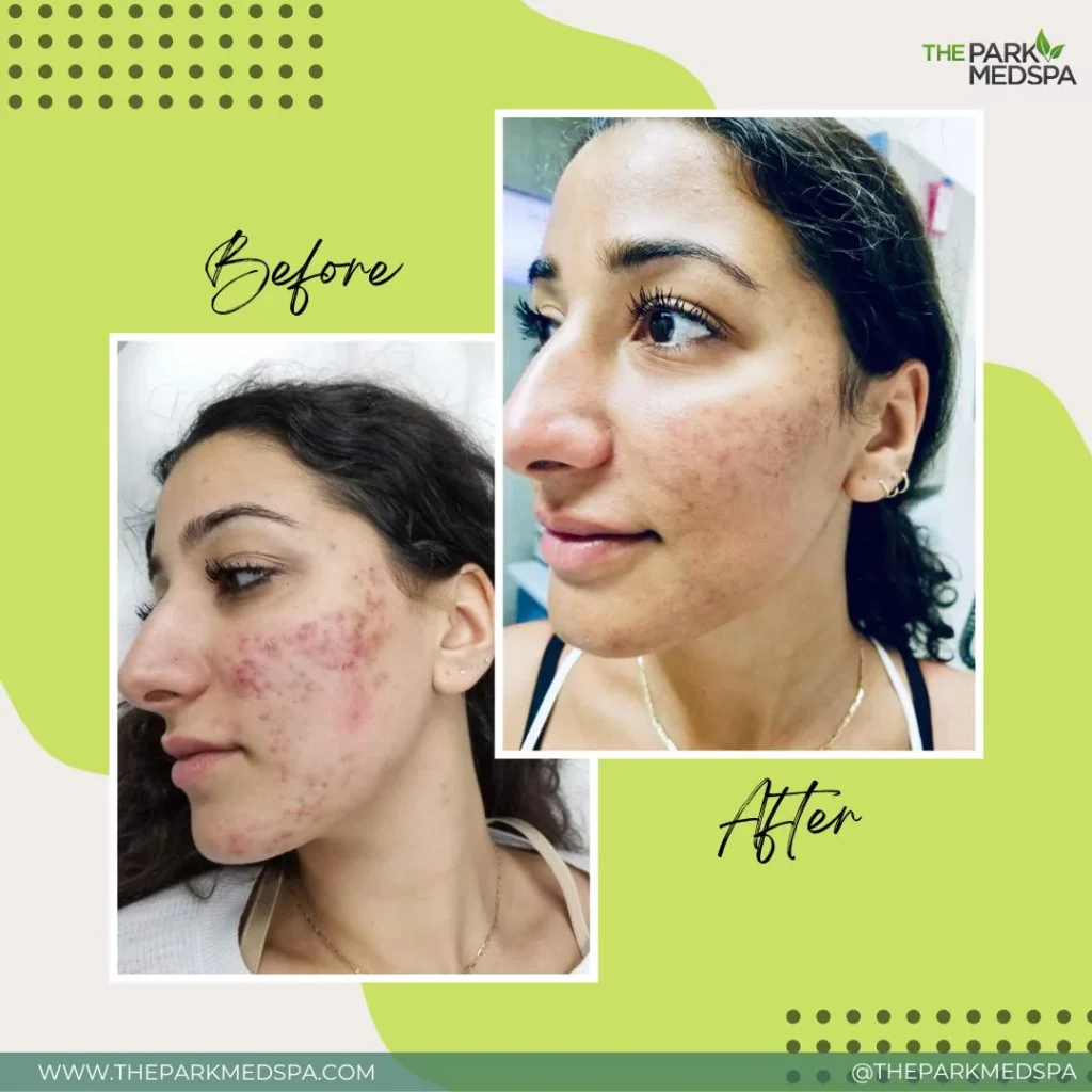 HOW TO GET RID OF ACNE: Preventions and Treatments 3 WHATS YOUR SKIN CONCERN WE CAN FIX IT after | HOW TO GET RID OF ACNE: Preventions and Treatments