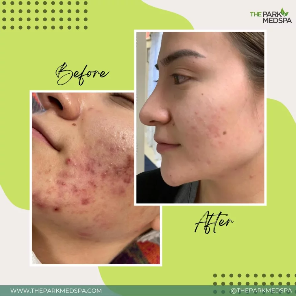 HOW TO GET RID OF ACNE: Preventions and Treatments 2 WHATS YOUR SKIN CONCERN WE CAN FIX IT before blog thepark medspa in Highland Park NJ | HOW TO GET RID OF ACNE: Preventions and Treatments