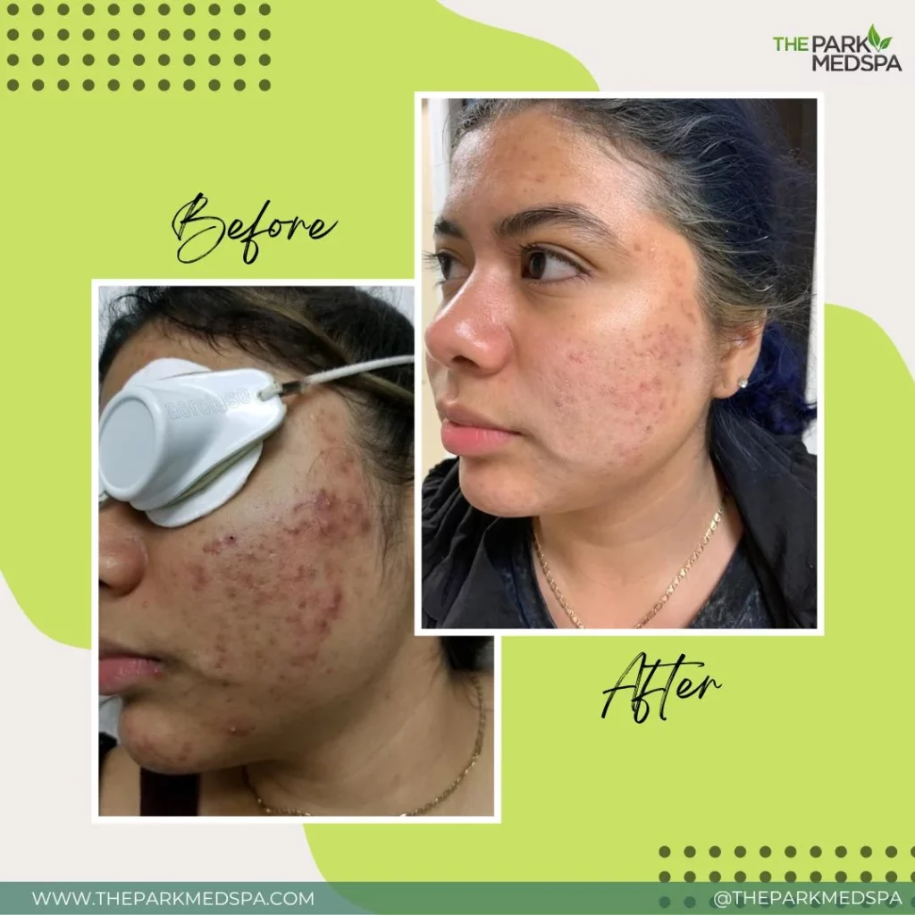 HOW TO GET RID OF ACNE: Preventions and Treatments 1 WHATS YOUR SKIN CONCERN WE CAN FIX IT blog thepark medspa in Highland Park NJ blog thepark medspa in Highland Park NJ | HOW TO GET RID OF ACNE: Preventions and Treatments