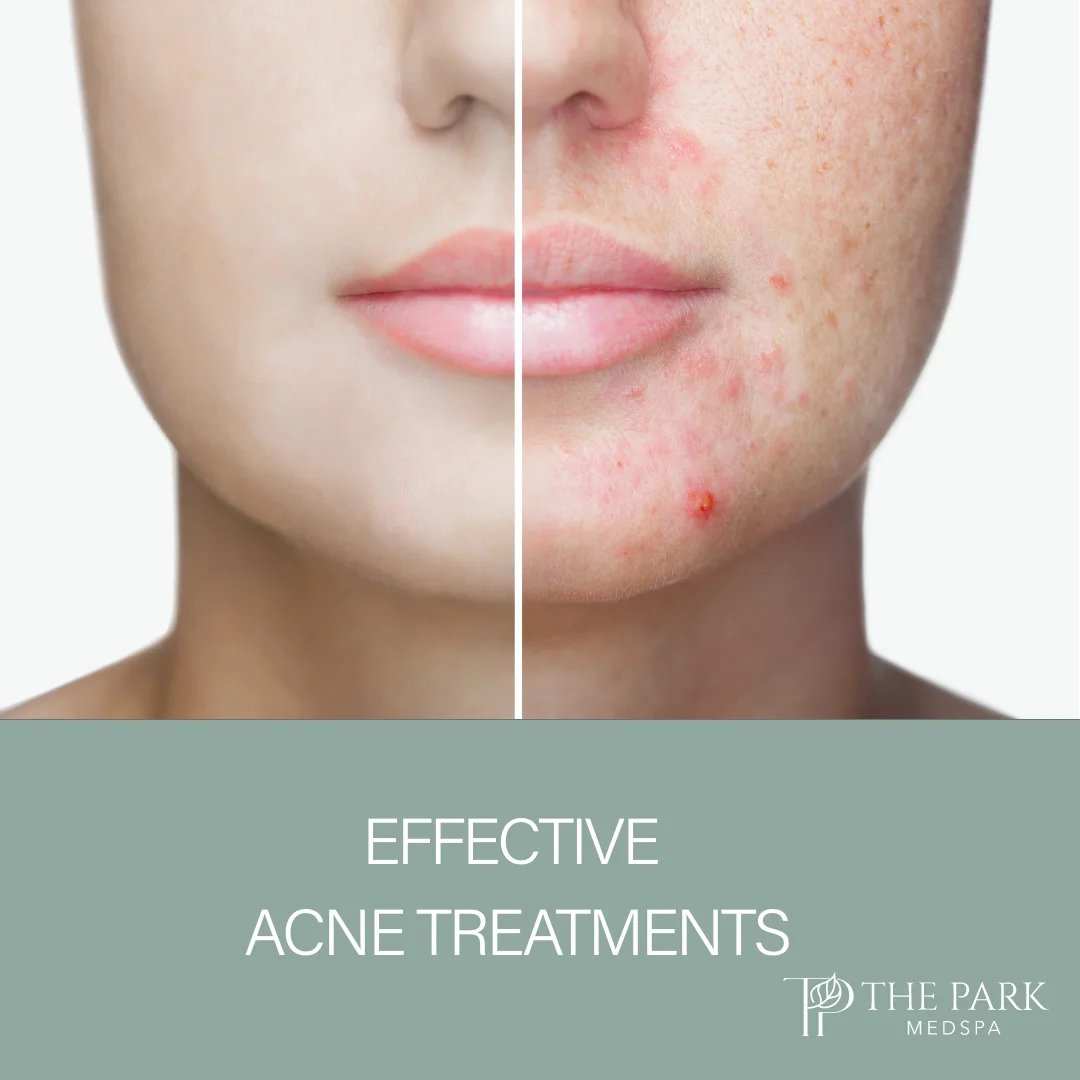 Acne Treatment at The Park Medspa in Highland Park, NJ
