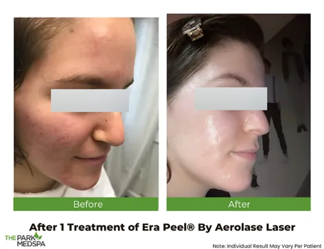 Microneedling vs. Laser Resurfacing: Which is Best for Skin Tightening? 2 laser microneedling blog thepark medspa in Highland Park NJ | Microneedling vs. Laser Resurfacing: Which is Best for Skin Tightening?