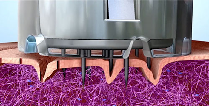 Microneedling 1 Benefits of SkinPen blog thepark medspa in Highland Park NJ | Microneedling