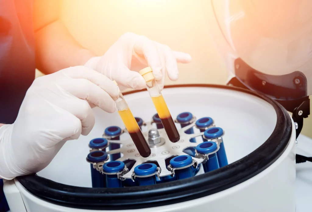 Portfolio 2 Platelet Rich Plasma Treatment at The Park Medspa in Highland Park, NJ