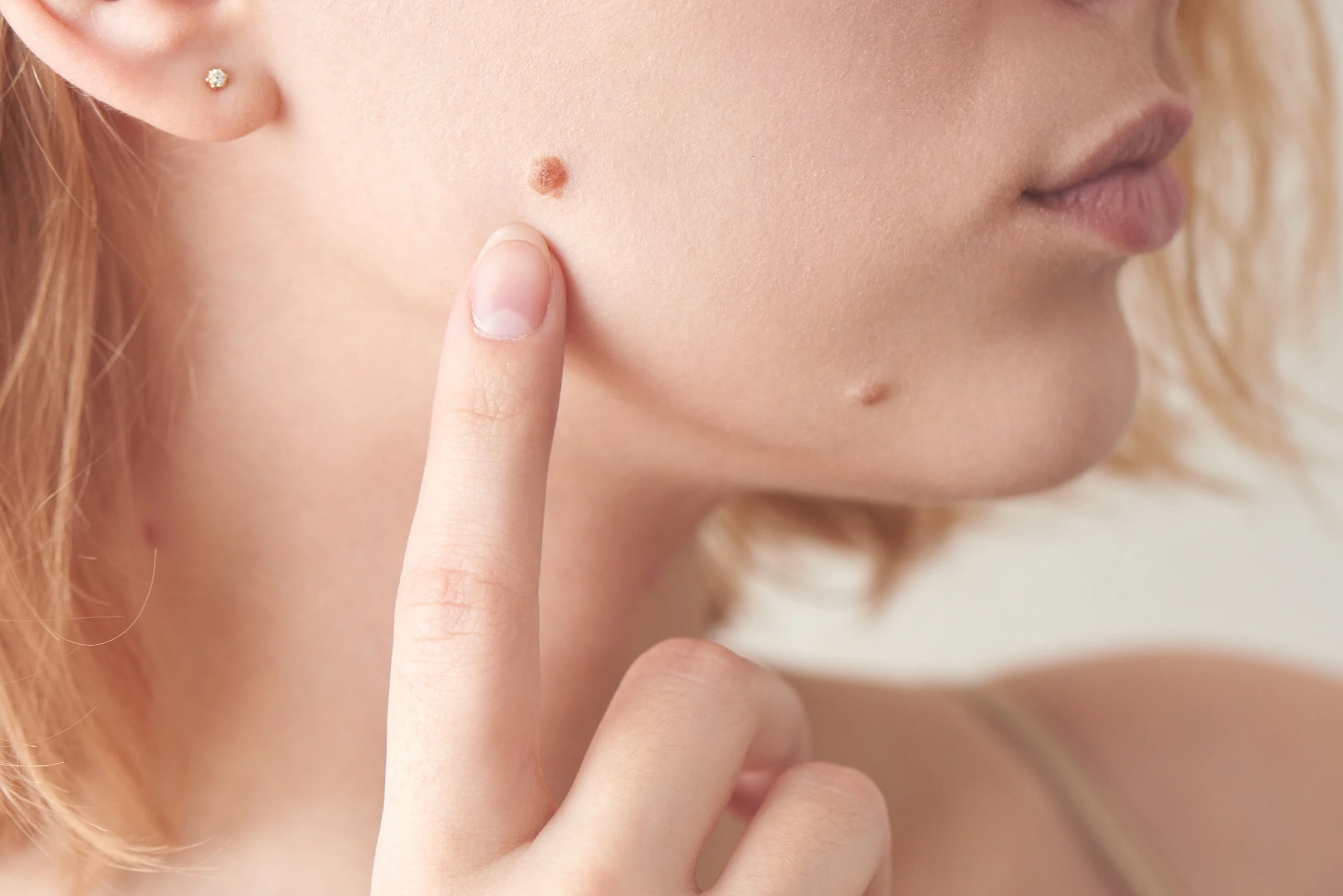 Causes of Moles and Skin Tags